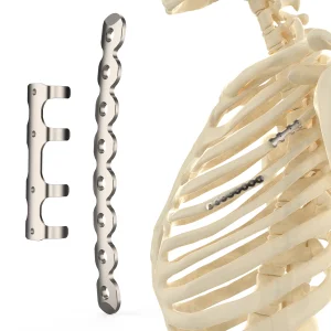 CANWELL Titanium Rib Locking Plate