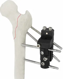 Titanium Bone Fixator