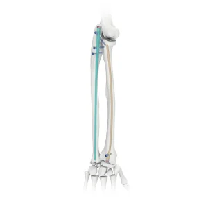 Radius & Ulna Intramedullary Nail Proximal Femoral Nailing System for Radius & Ulna Fractures Titanium Alloy CE Certified