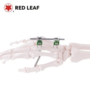 Mini External Fixator