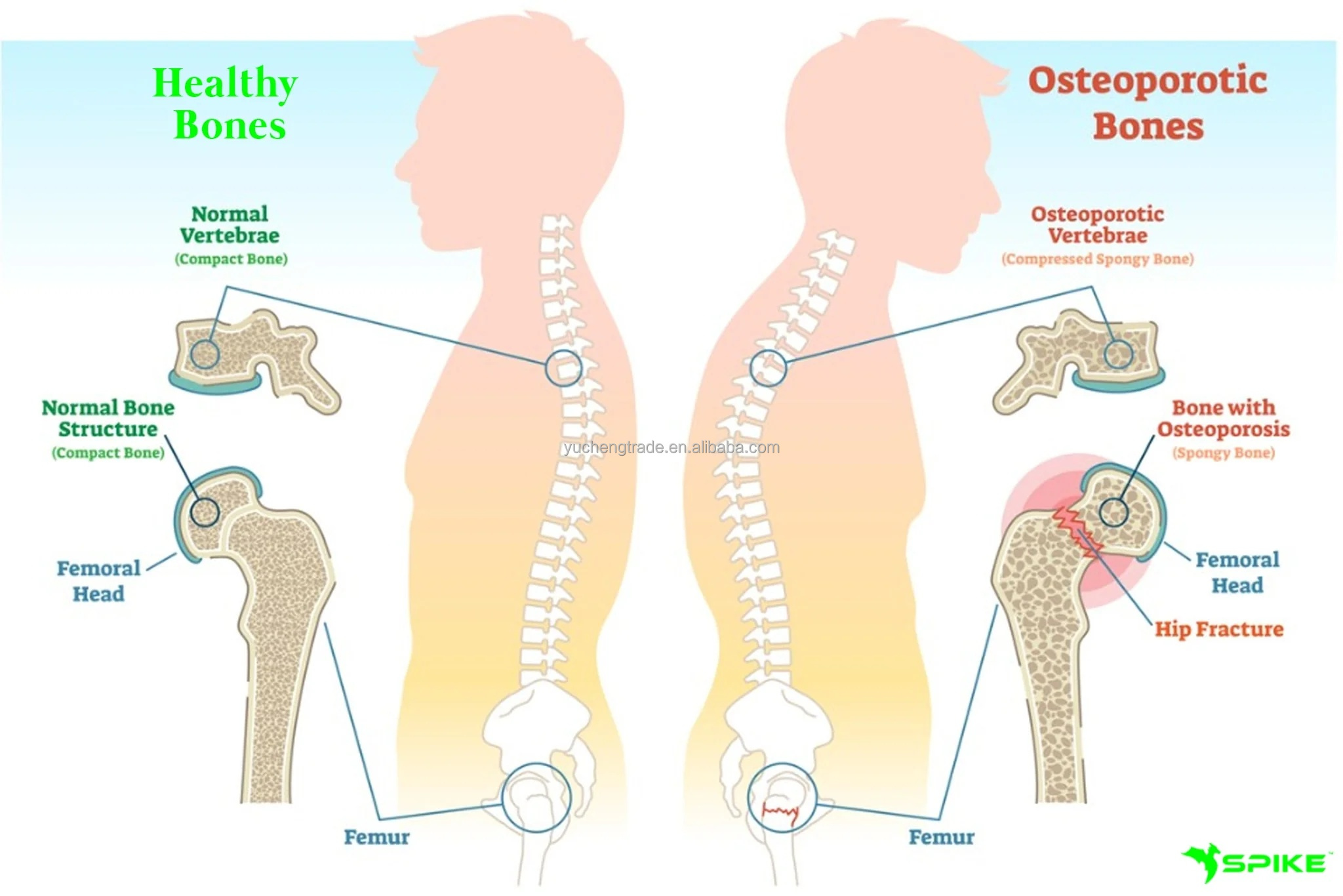 Promotes Close Binding With Bone Density