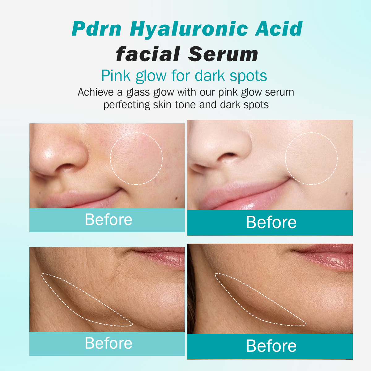 PDRN Serum With Salmon DNA, Hyaluronic Acid &amp; Collagen, Face Anti-Aging Firming, Plumping, Korean Recipe Skincare, 30ml