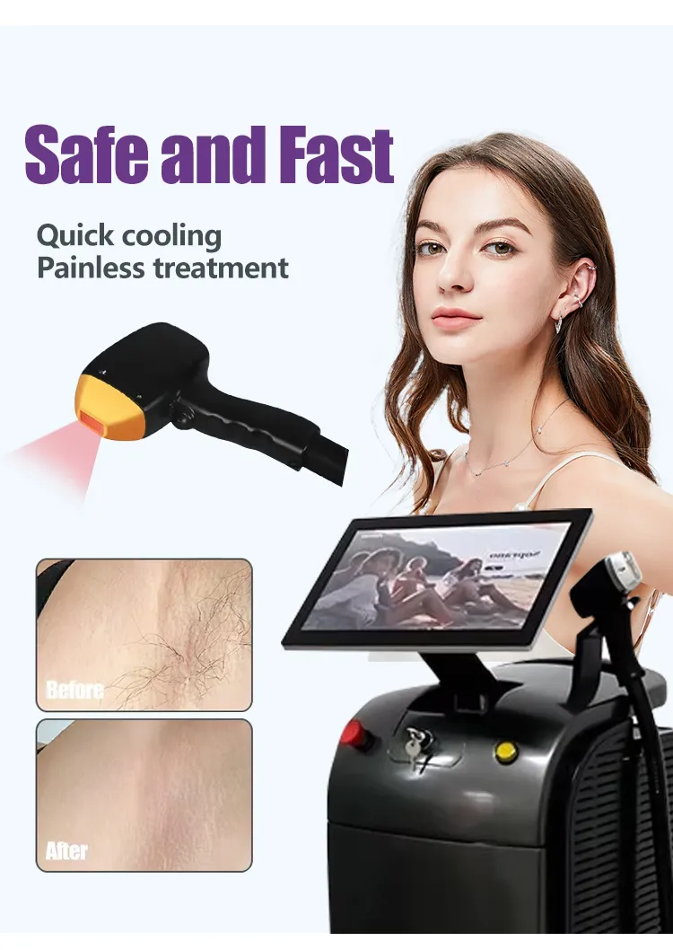 Diode Laser Hair Removal