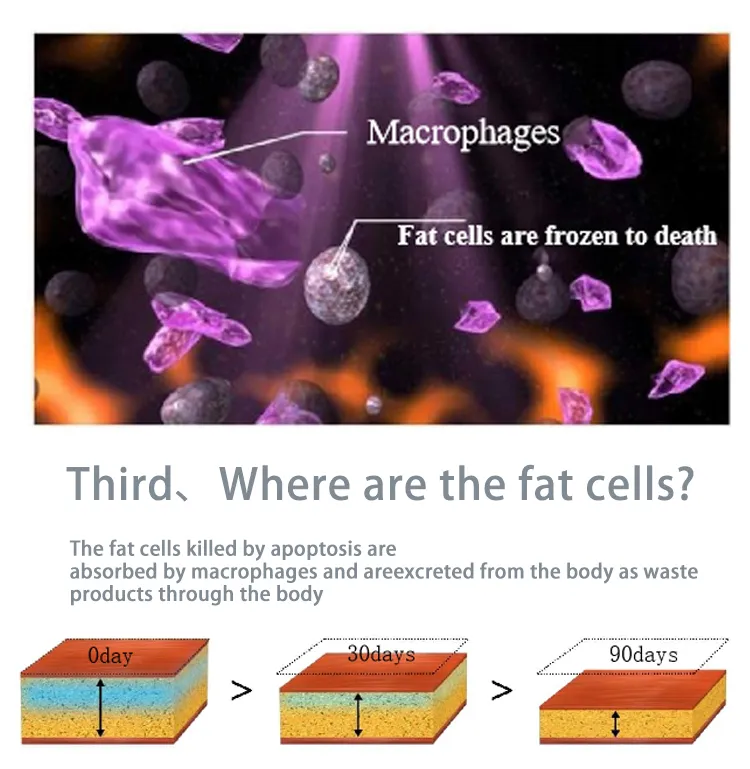 Slimming Cellulite Removal