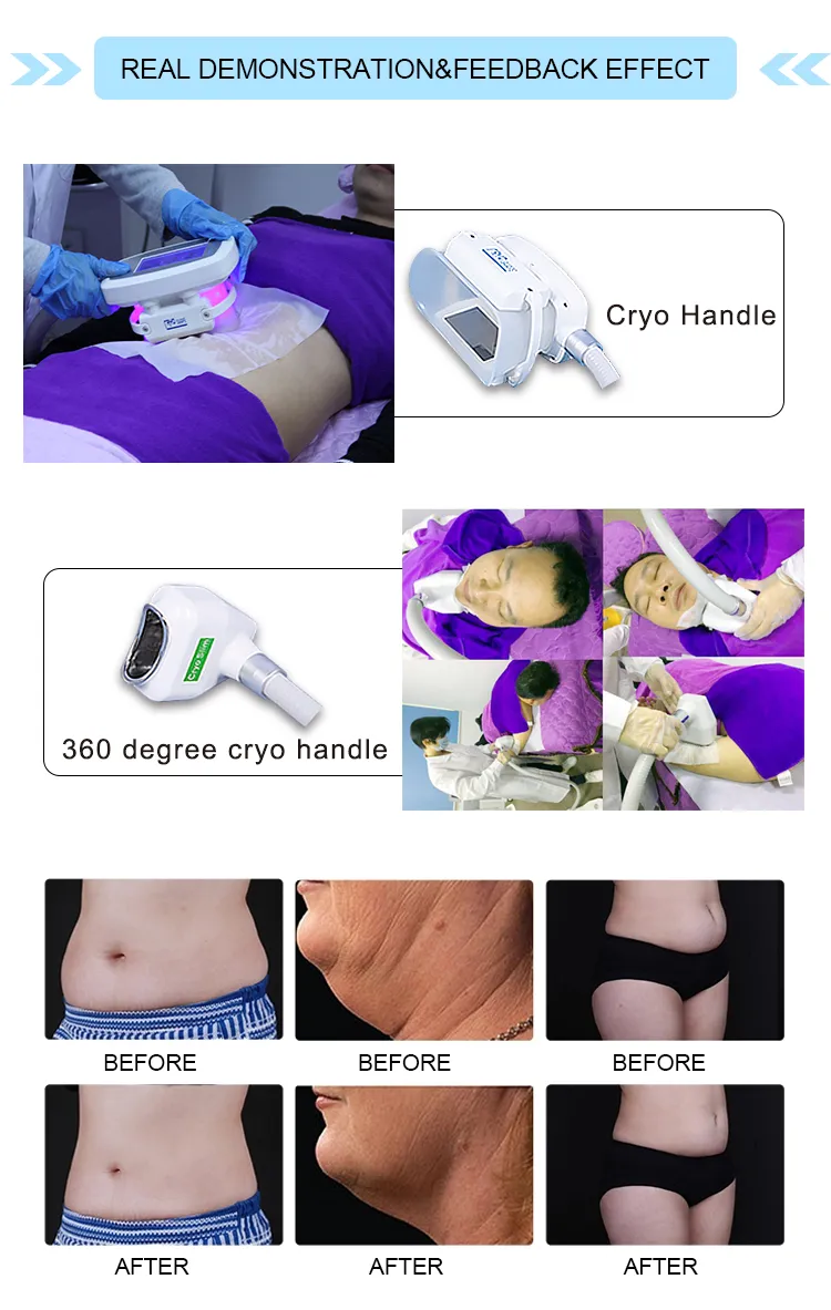 Cryolipolysis Device 10