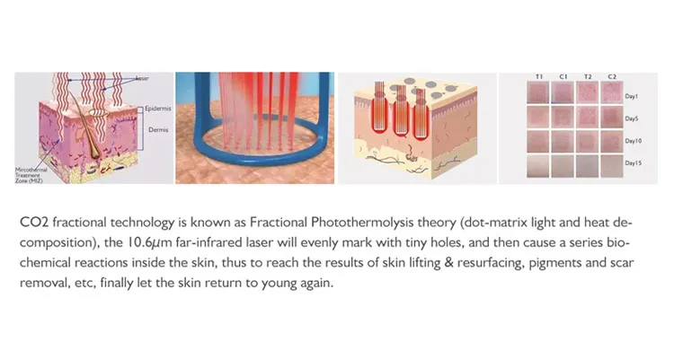 Laser Skin Rejuvenation Principle