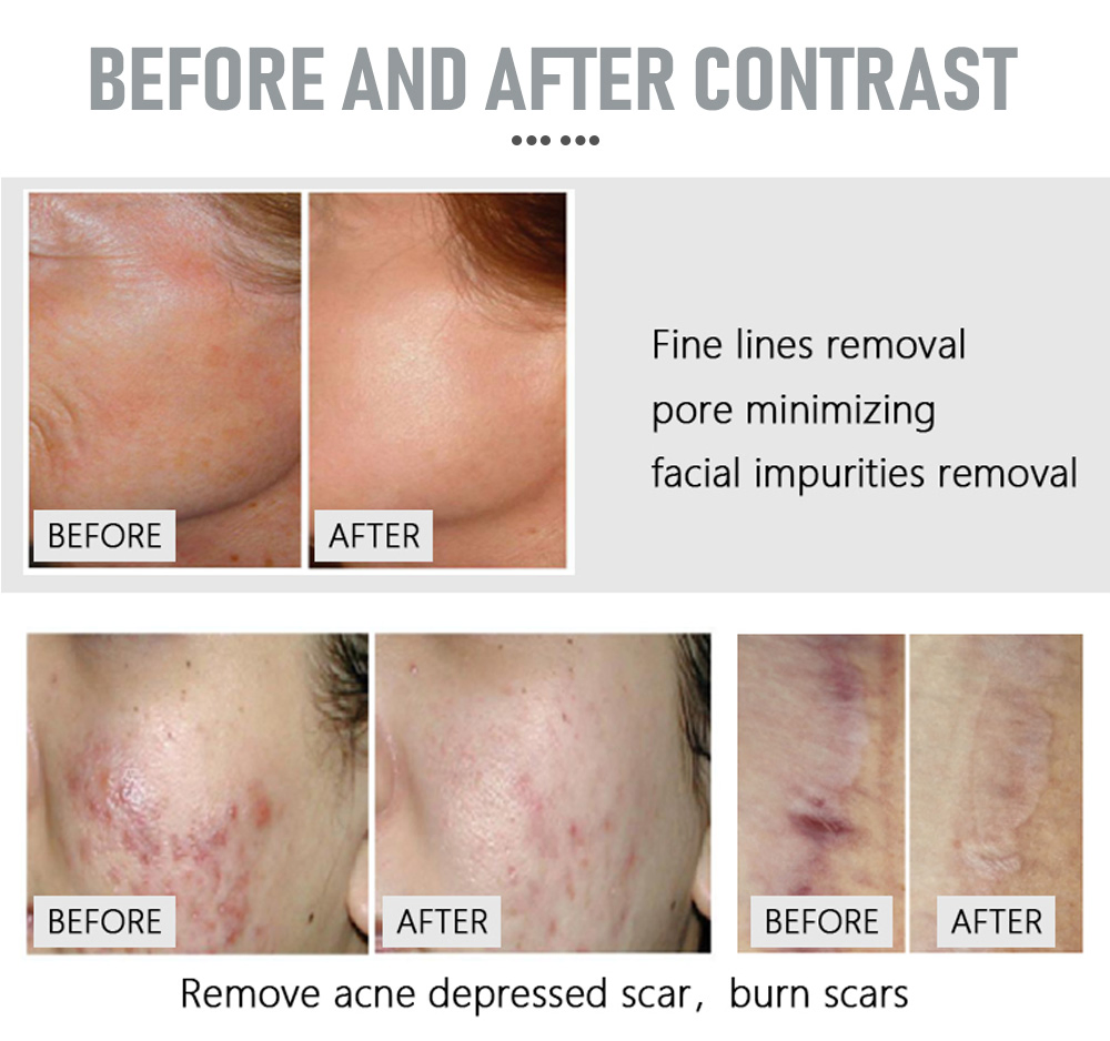 Fractional CO2 Laser Skin Rejuvenation Scar Resurfacing Vaginal Tightening Beauty Machine