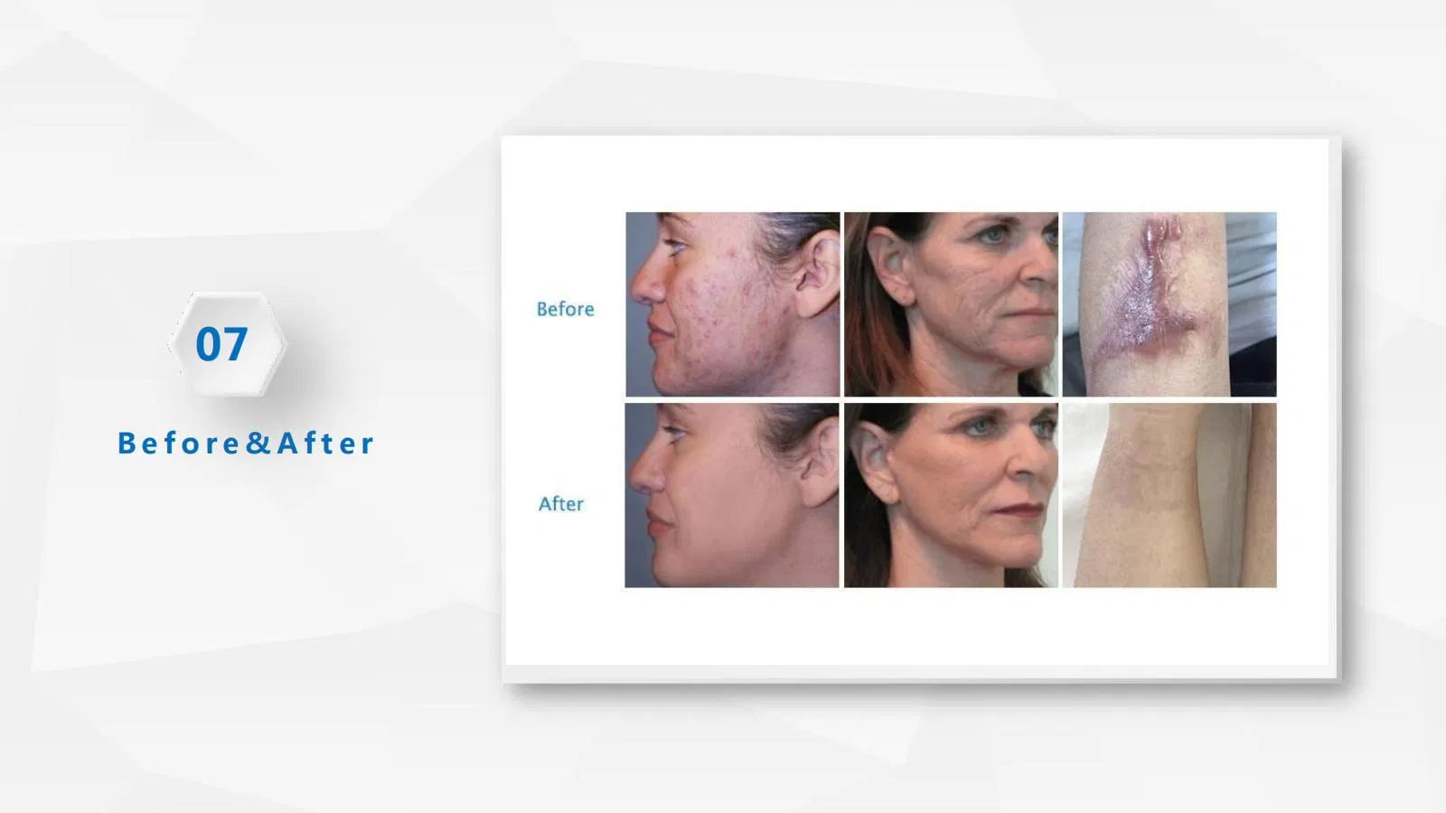 Fractional CO2 Laser for Scar Removal Vaginal Tightening Skin Whiten Wrinkles Removal