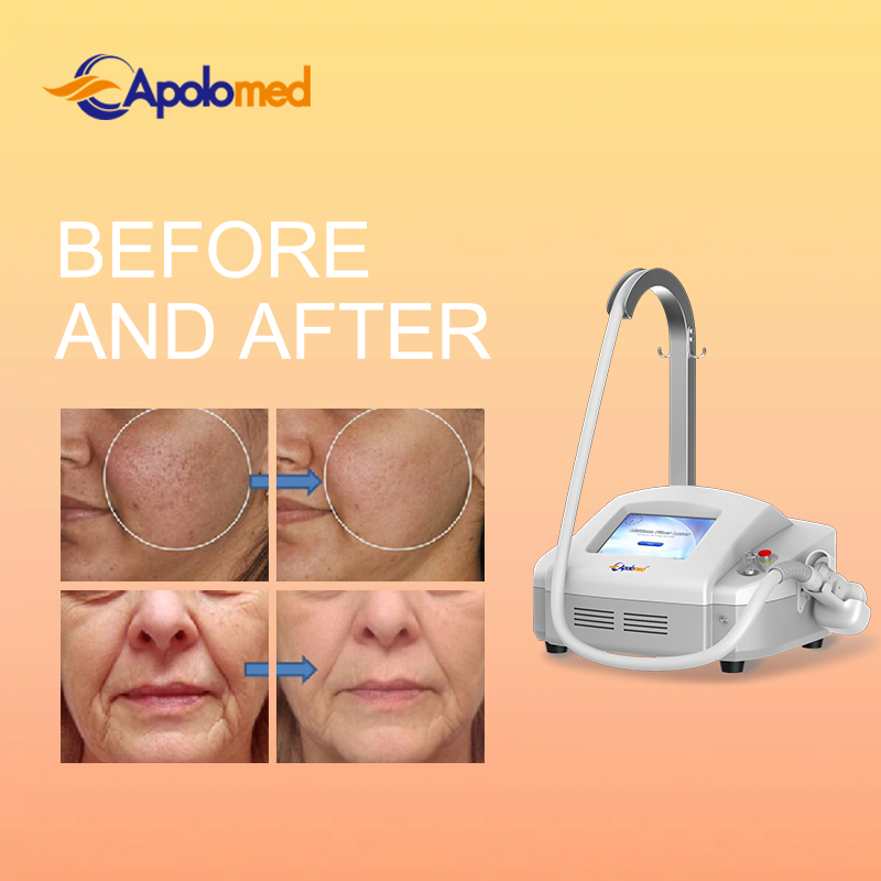1550nm Fractional Apolo Exclusive Designed Er Glass Laser with Good Treatment Result
