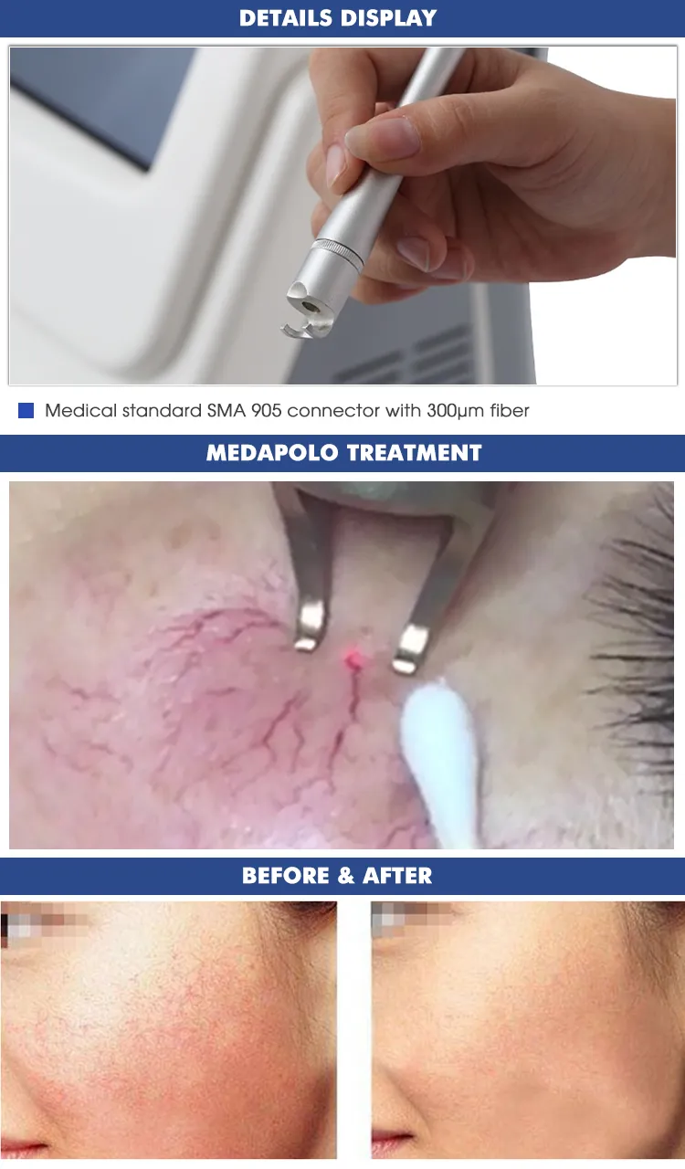 Cherry Angiomas Before After