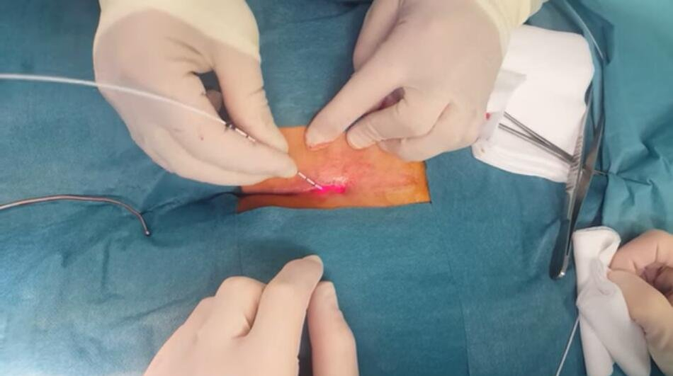 30W 17W Latest Technology Multi-Functions Diode Laser 1470nm 980nm Anal Fistula Surgery Laser Treatment / 1470nm Hemorrhoids Laser