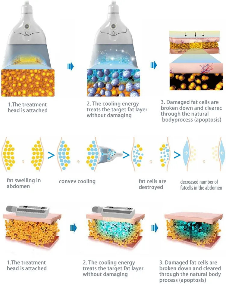 Fat Freezing Technology