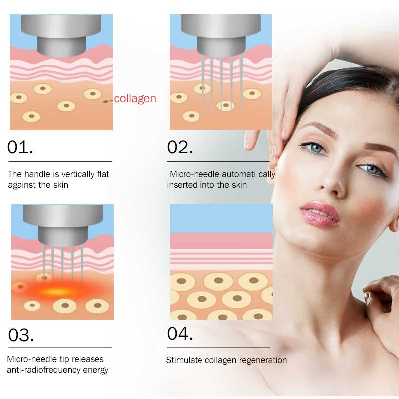 Advanced Radio Frequency Microneedling Machine for Face Lifting