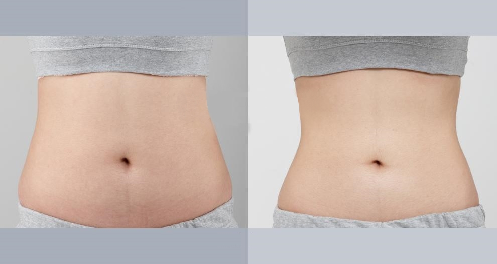 High Power Spider Permanent Vein Laser Removal Hemorrhoids Liposuction Fiberlift Device