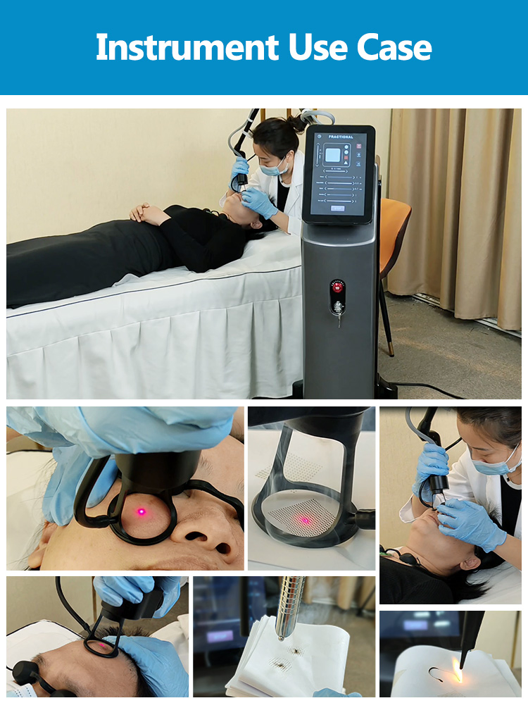 Medical CE Approved 40 W Fractional CO2 Stretch Mark Removal Medical Fractional CO2 Laser