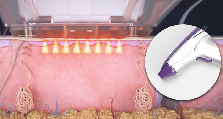 Fractional Microneedling RF Fractional Radio Frequency Beauty Equipment Matrix for Salon Facelift Skin Tightening