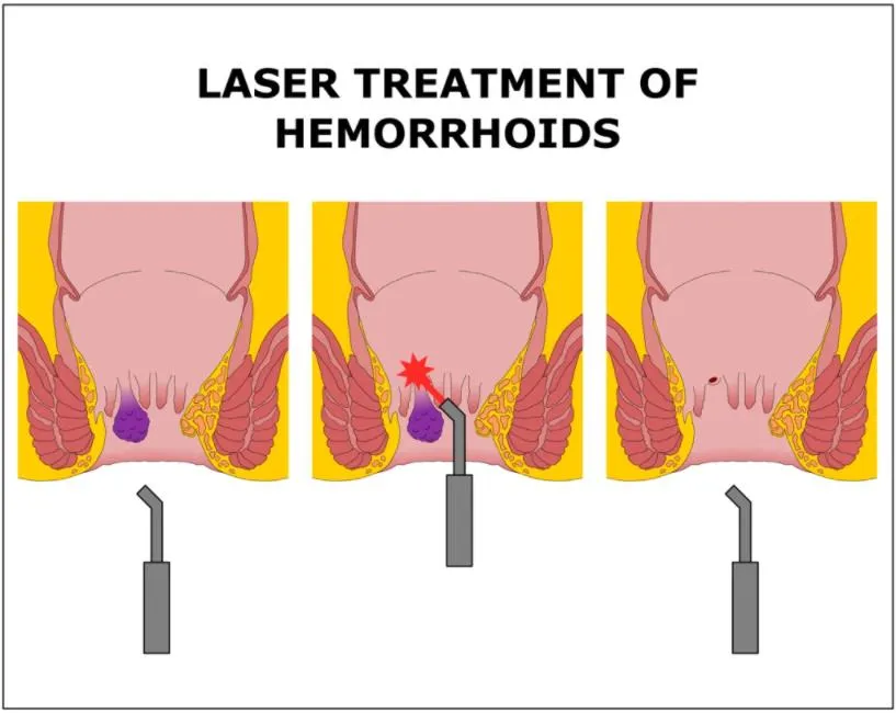 Laser Reconstruction