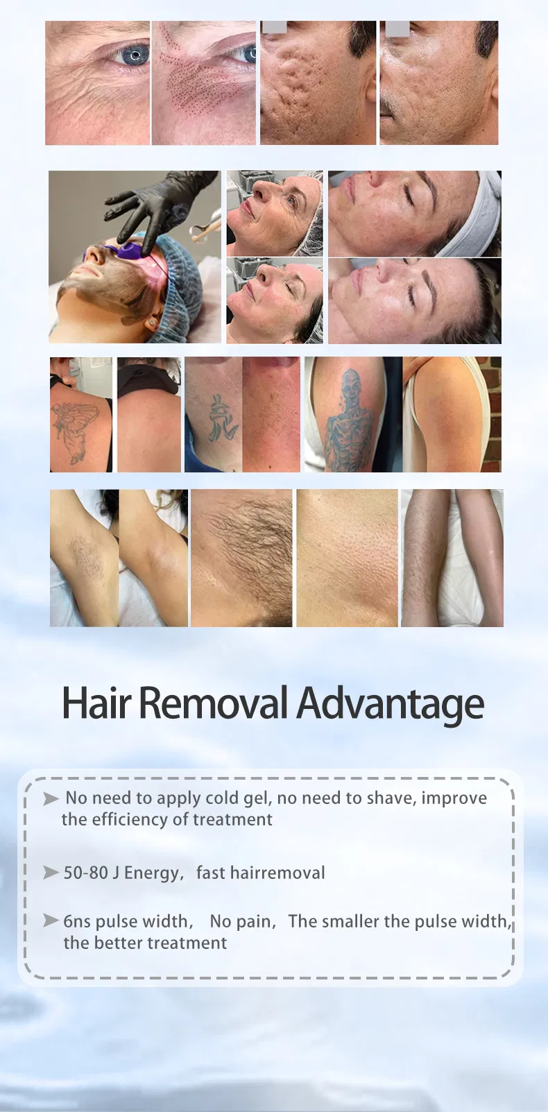 Melasma Removal Results