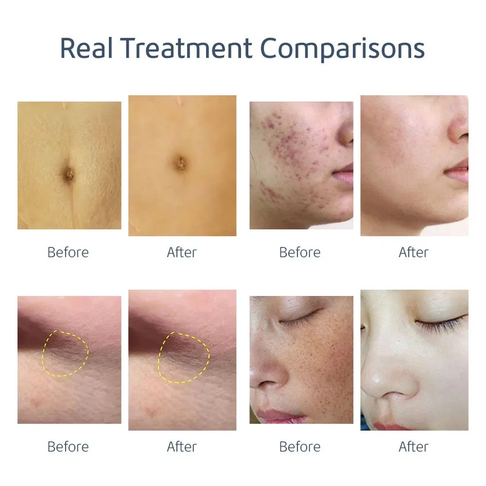 CO2 Fractional Laser Machine Beauty Skin Rejuvenation Acne Stretch Marks Scar Wrinkle Remover