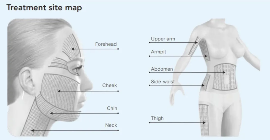 Hifu Equipment Overview