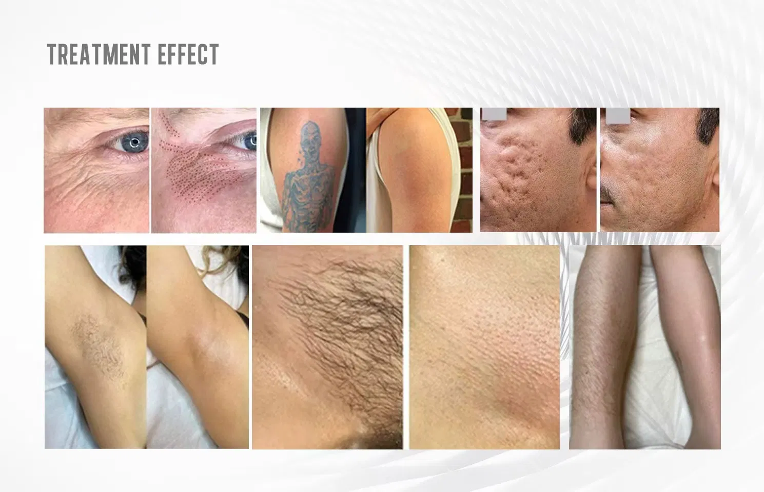 New 808 Diode Laser Permanent Hair Removal 2in1 Q Switched ND YAG 755 Nm Picosecond Laser Tattoo Removal Machine