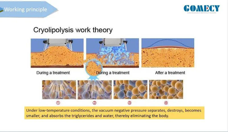 Fat Freezing Application