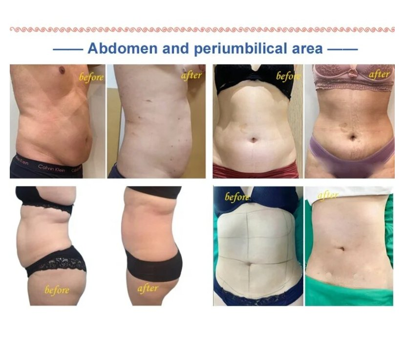 980nm 1470nm Diode Laser Varicose Veins Treatment Fat Reduction Liposuction Machine D Laser 1470 Visage