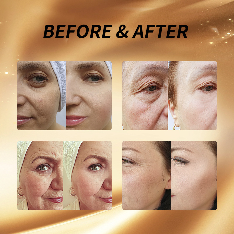 Ultrasound 360 Max Anti Wrinkle Removal Body Firming RF EMS Skin Tighten Face Lifting 25D Hifu Machine