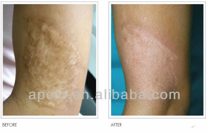 Scar removal effect
