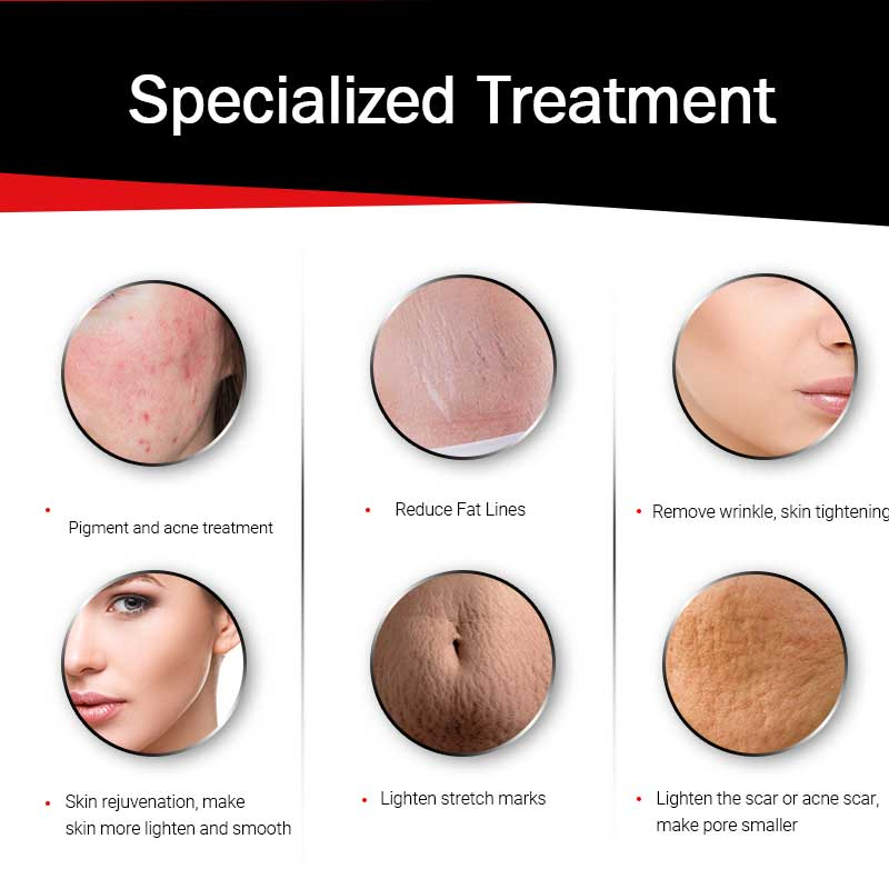 Advanced Radio Frequency Microneedling Machine for Face Lifting