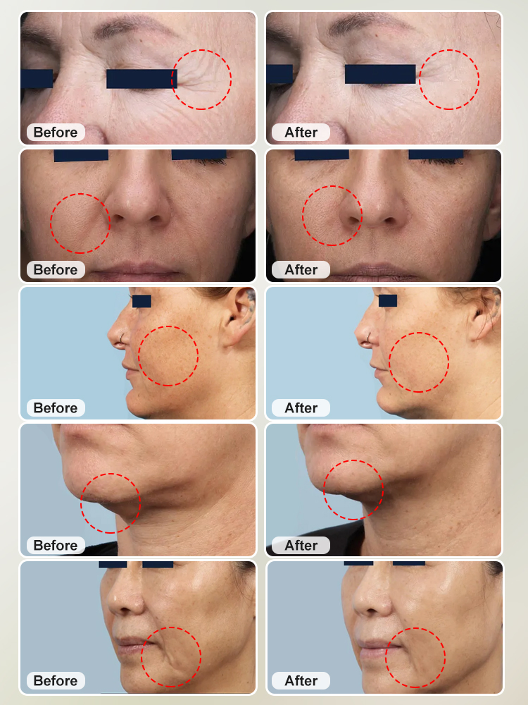 Fractional Microneedling RF Fractional Radio Frequency Beauty Equipment Matrix for Salon Facelift Skin Tightening
