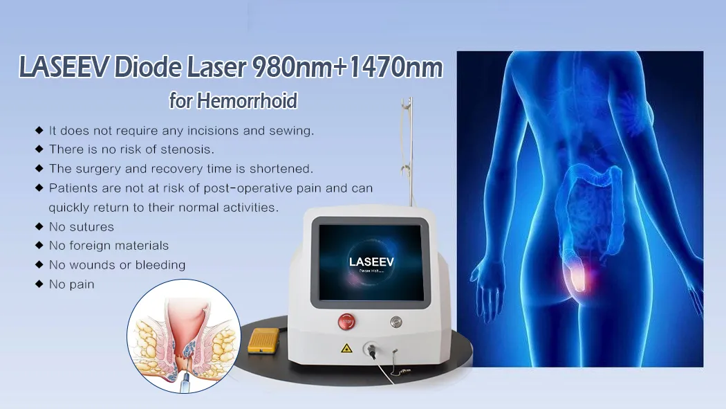 Hemorrhoids Laser Technology