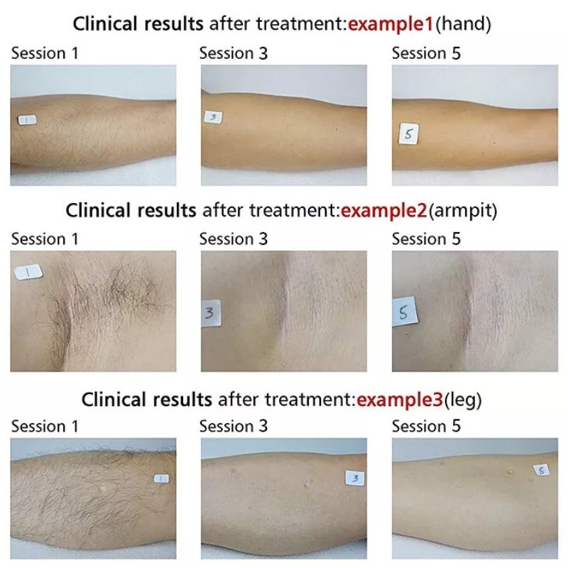 Powerful Diode Laser Hair Removal System with Advanced Cooling Technology