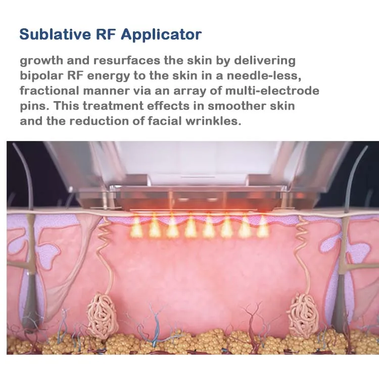 Sublative RF Applicator