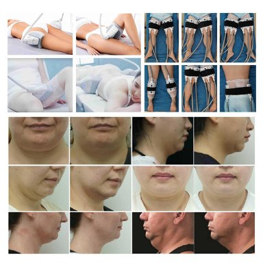 Cryo Cryolipolysis Fat Freezing Weight Loss Slimming Cellulite Removal Cryolipolysis Machine