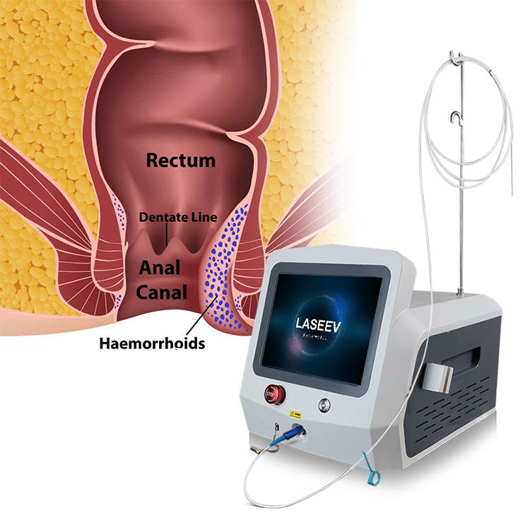 30W 17W Latest Technology Multi-Functions Diode Laser 1470nm 980nm Anal Fistula Surgery Laser Treatment / 1470nm Hemorrhoids Laser