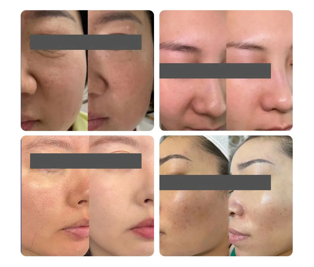 Before and After Results