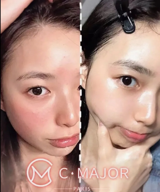 French Imported Cmajor Whitening, Anti-Aging, Mesotherapy and Skin Care Injection