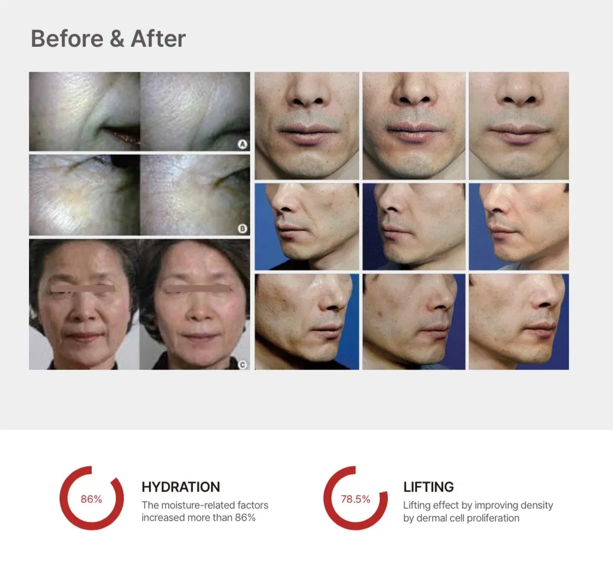 Save B32 B32sp Skin Booster High Law Molecular Ha 2.5ml Ha+ 32mg 64mg Succinic Acid Princess Volume Ultrahilo Skin Care