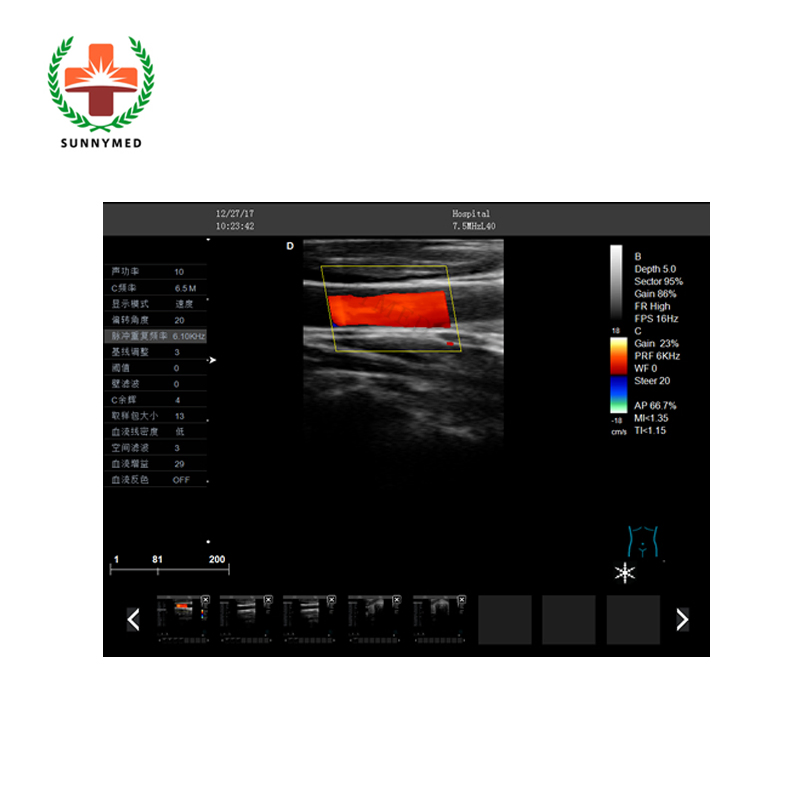 Sy-A028c Carro de Ginecología y Obstetricia 2D Máquina de Ultrasonido Doppler Color