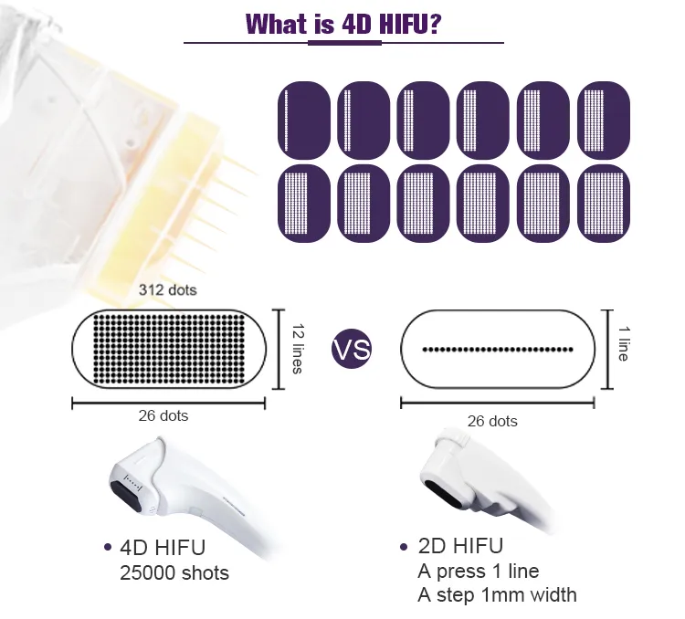 4D HIFU Technology