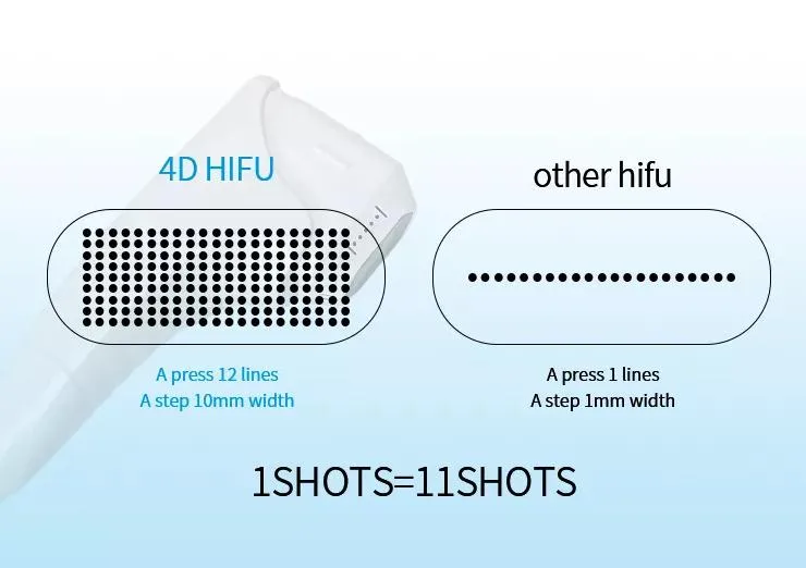 Parámetros 4D HIFU