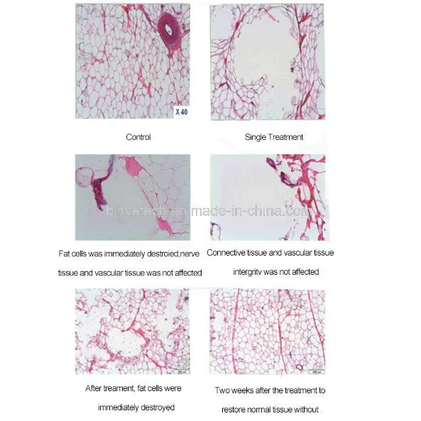 HIFU máquina de adelgazamiento Liposonix