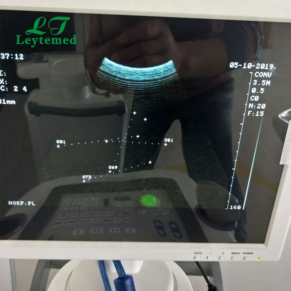 Ltub28 Máquina de ultrasonido móvil Doppler de trolley para vejiga, cardíaca y renal en blanco y negro
