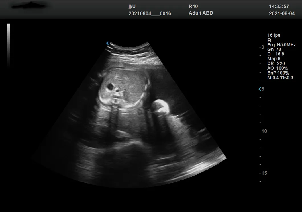 Abdomen fetal