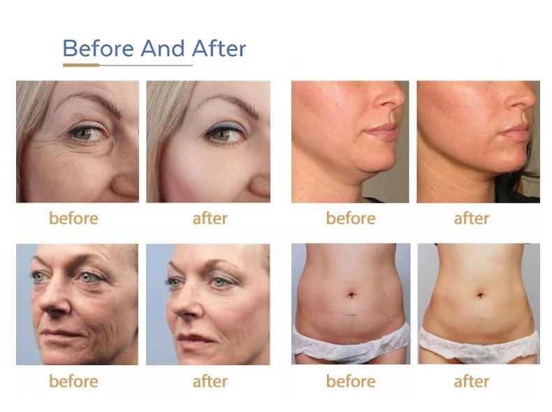 Equipo de belleza ultrasónico para el levantamiento facial antienvejecimiento, firmeza, eliminación de arrugas y adelgazamiento corporal Mptstl 12D Tt Hifu Machine