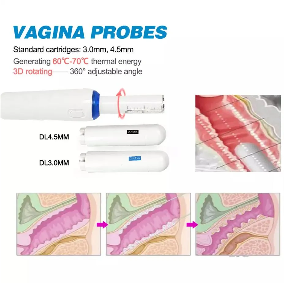 Hifu Vaginal