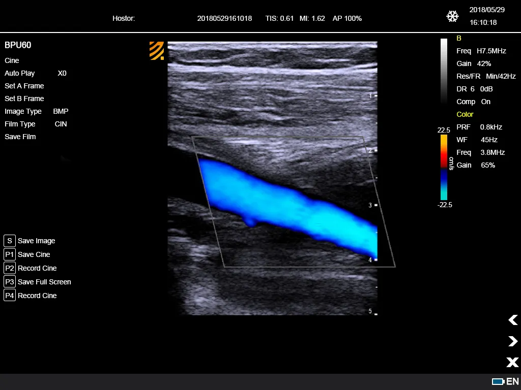 Ultrasonido Doppler Color 5
