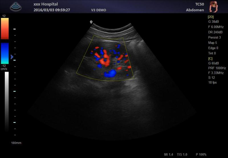 Ltub06 Todo Sistema de Diagnóstico Cardíaco Abdominal Digital por Ultrasonido con Doppler Color