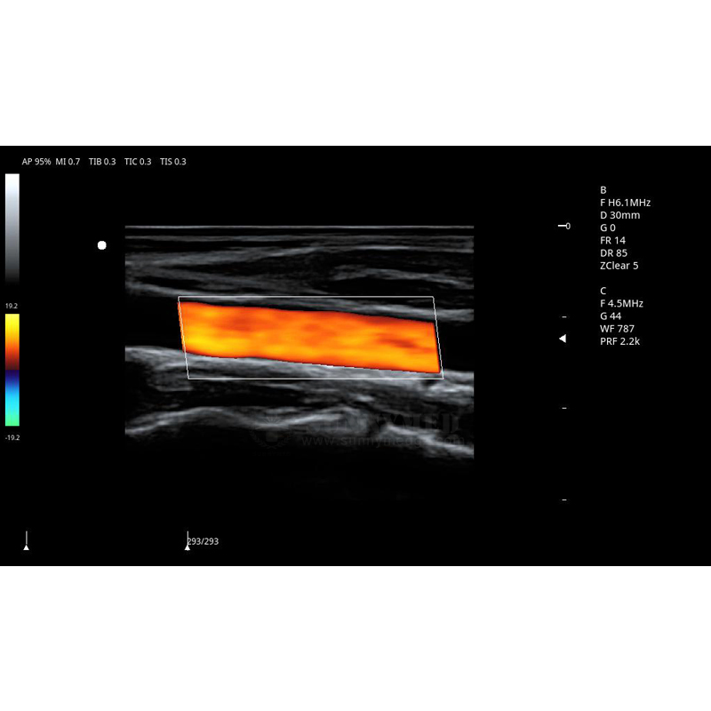 Sistema de ultrasonido Doppler color